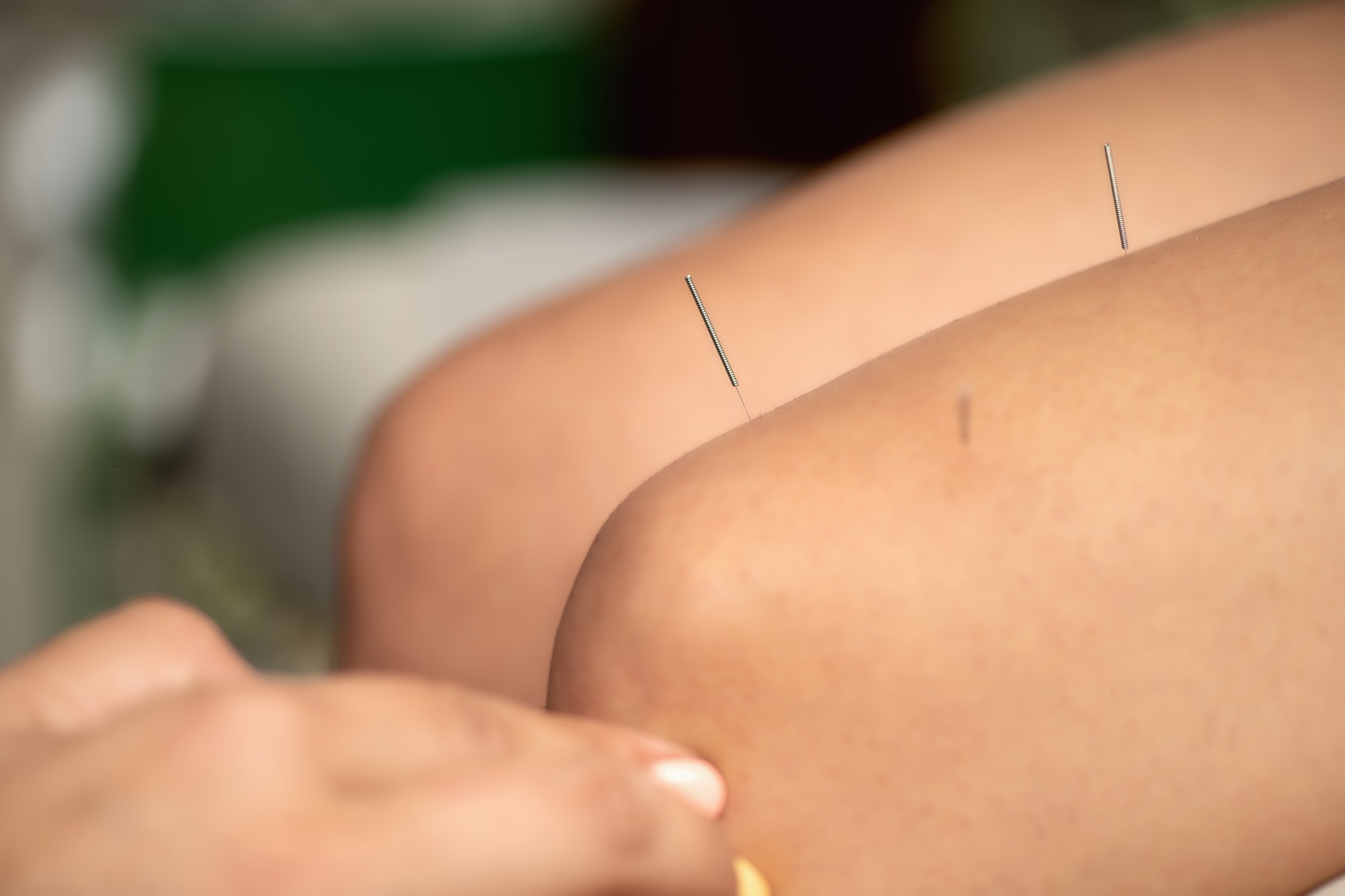 Acupuncture for Knee Pain