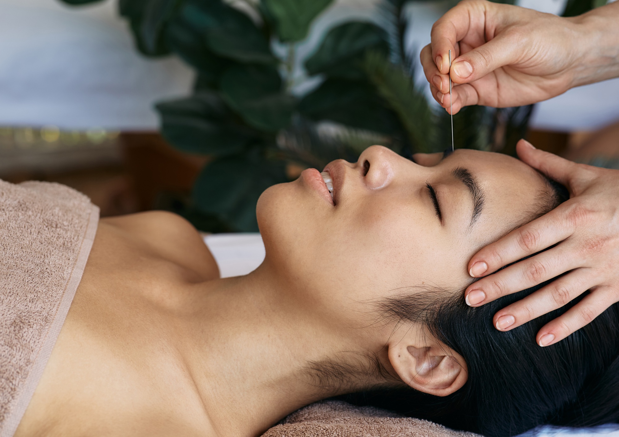 acupuncture for headache