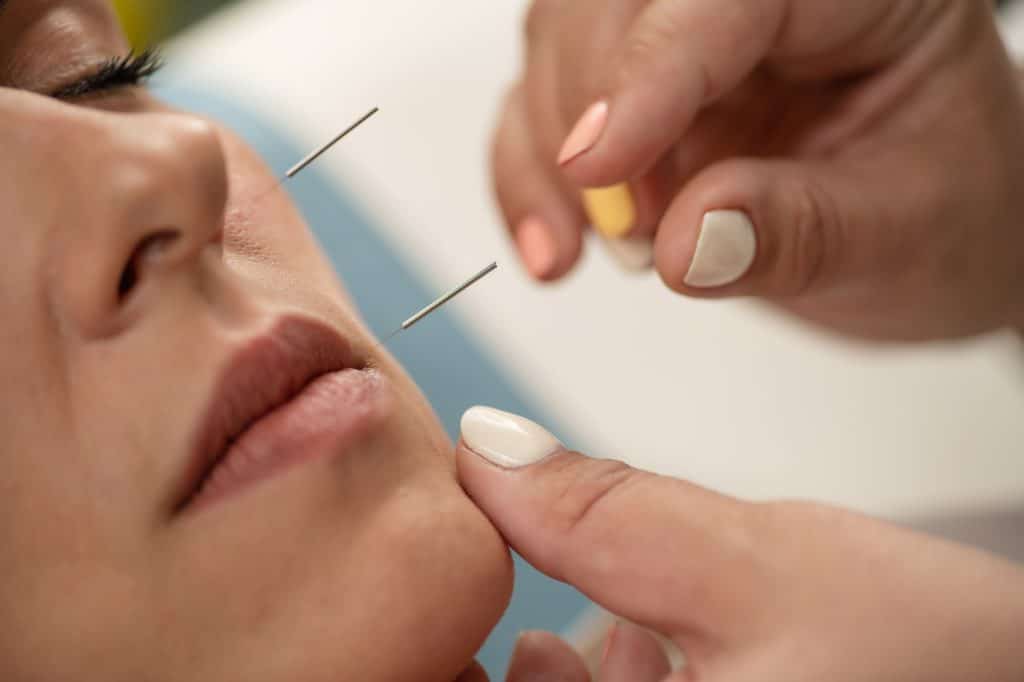 Acupuncture Treatment for Nervus Facialis