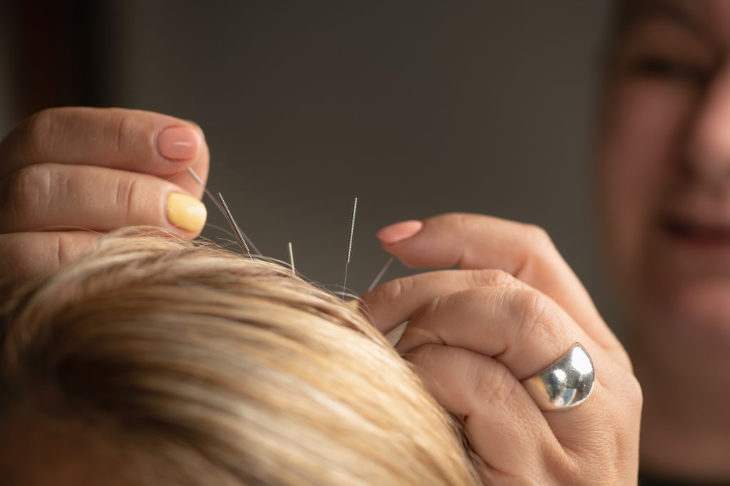 TCM acupuncture for stress