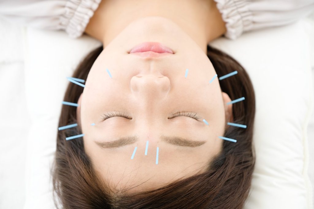 acupuncture treatment
