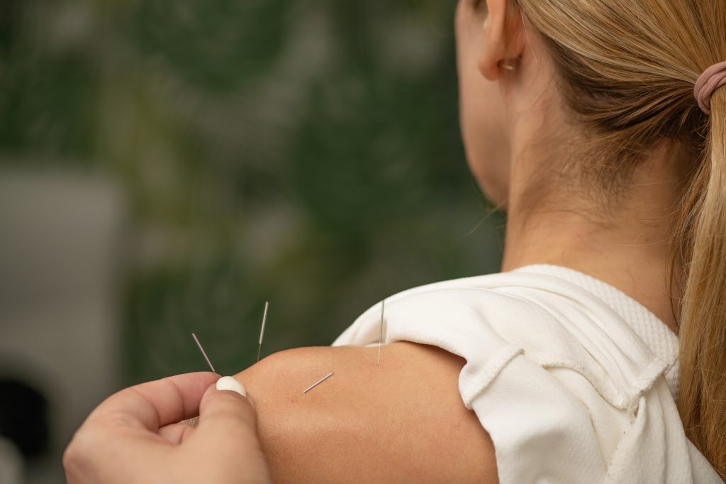 acupuncture for back pain
