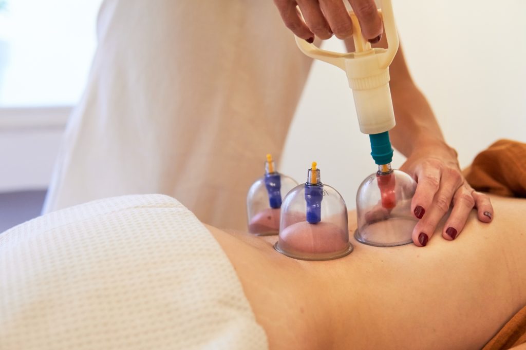 cupping therapy acupuncture
