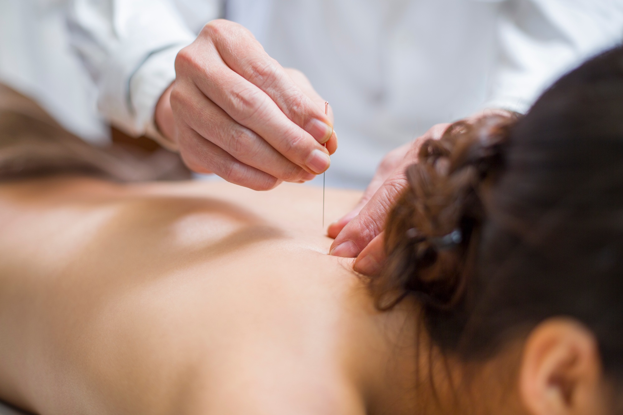 acupuncture for sciatica